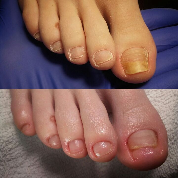 Antes y después de aplicar la crema Brand Exodermina rand de Yesenia