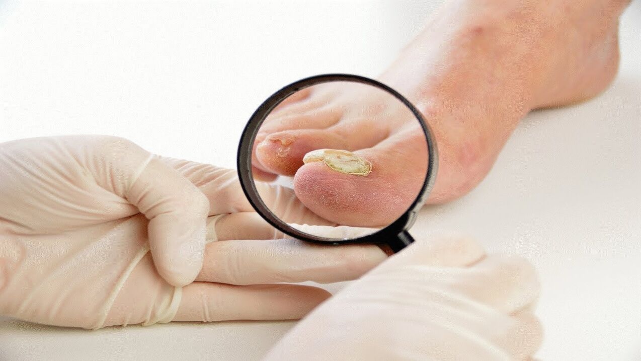 Todo sobre la micosis