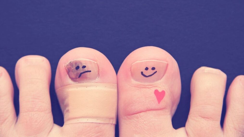 una uña con hongos y otra sana