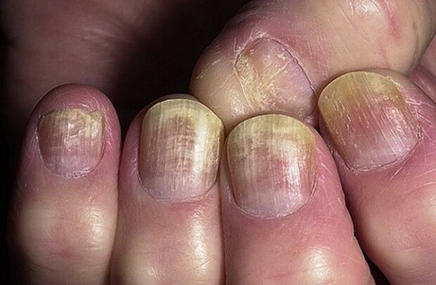 uñas infectadas con hongos Candida