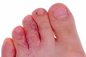 hongos en los dedos de los pies